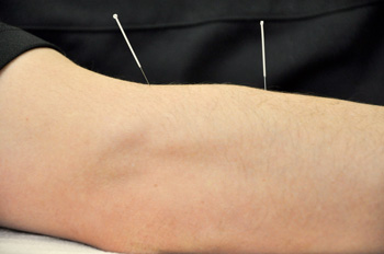 InSync Physiotherapy - Acupuncture Treatment